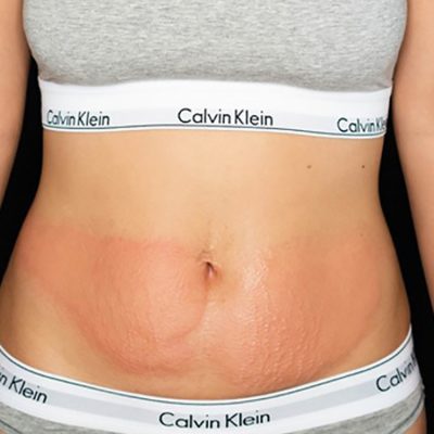 Cryoskin Cryotherapy for Slimming in Harker Heights, TX