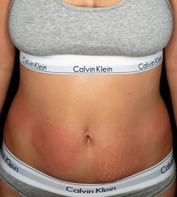 CryoSlimming-Abdomen-Before-750x850