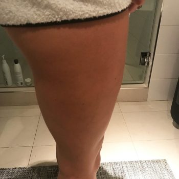 Toning-After-Cellulite