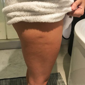 Toning-Before-Cellulite (1)